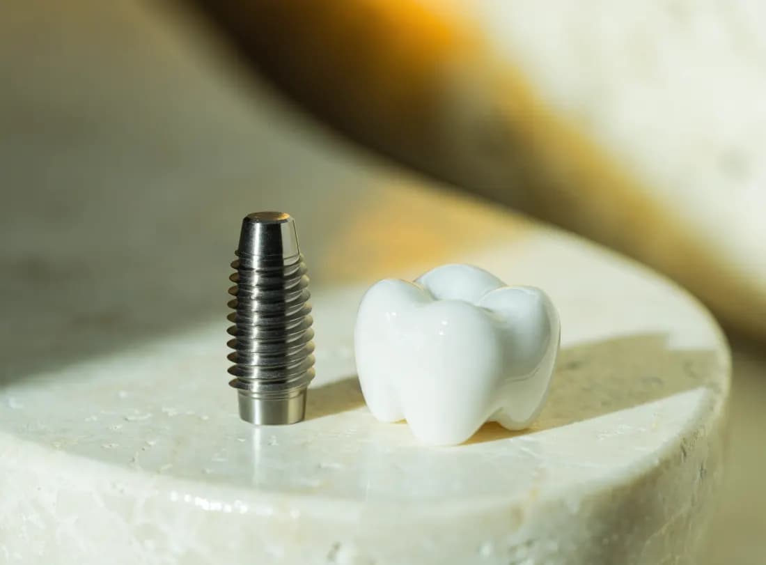 Dental implant